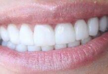 5 причин установить виниры